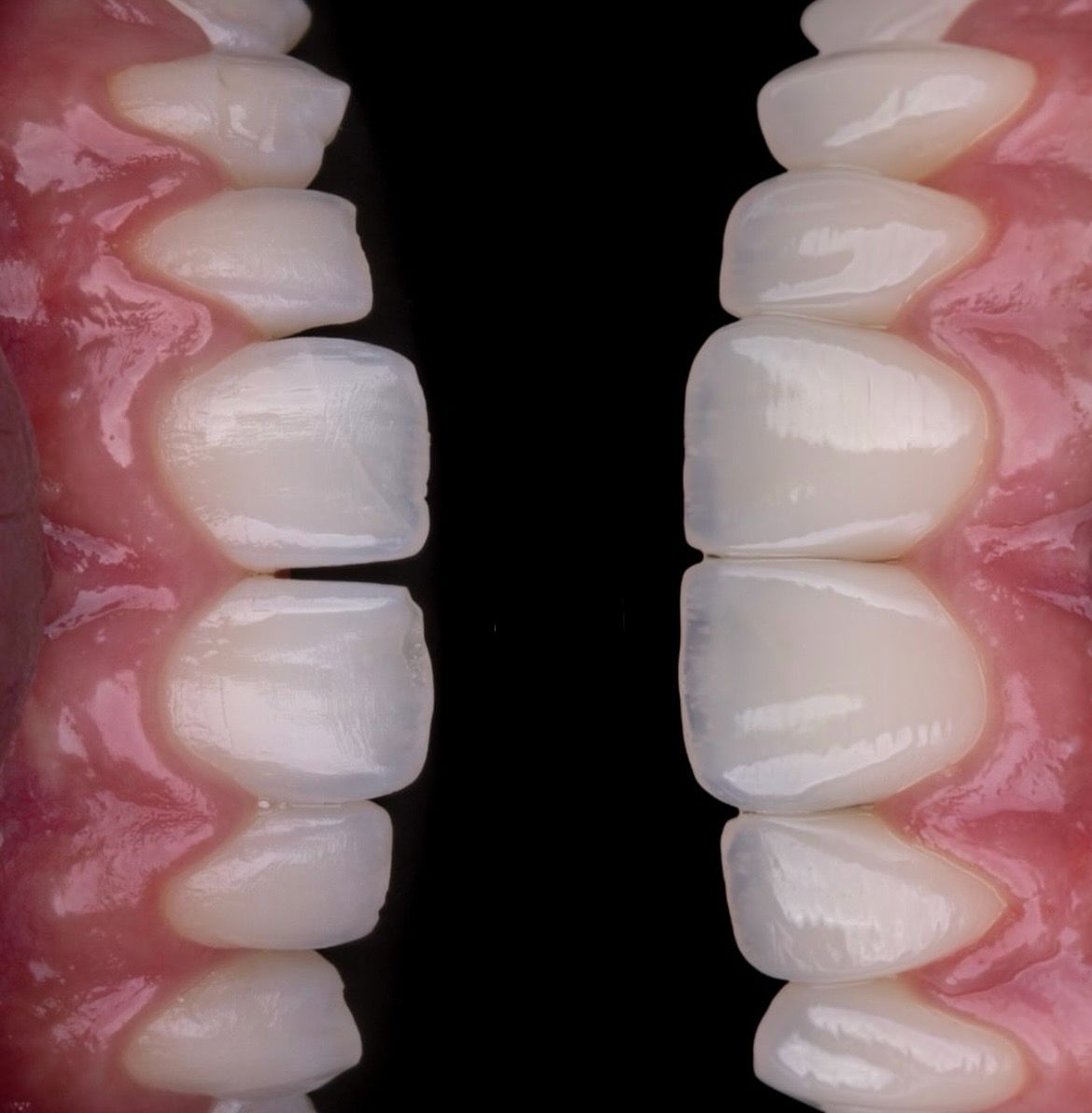 Faceta em resina | Dra. Beatriz Schmidt em Campos do Jordão