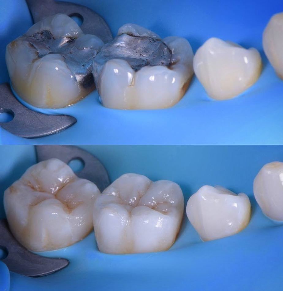 Restauração dentária realizado pela Dra. Beatriz Schmidt em Campos do Jordão
