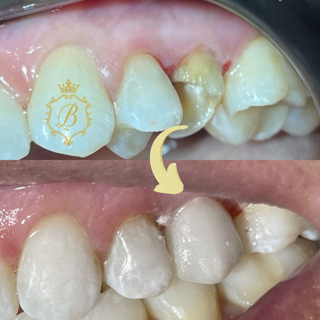 Coroa dentária | Dra. Beatriz Schmidt em Campos do Jordão